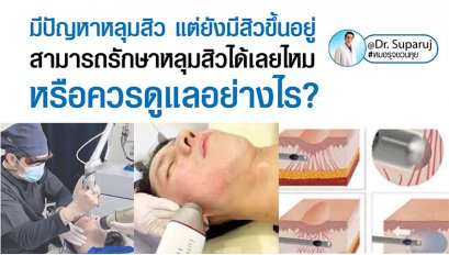 มีปัญหาหลุมสิว แต่ยังมีสิวขึ้นอยู่ สามารถรักษาหลุมสิวได้เลยไหม หรือควรดูแลอย่างไร?